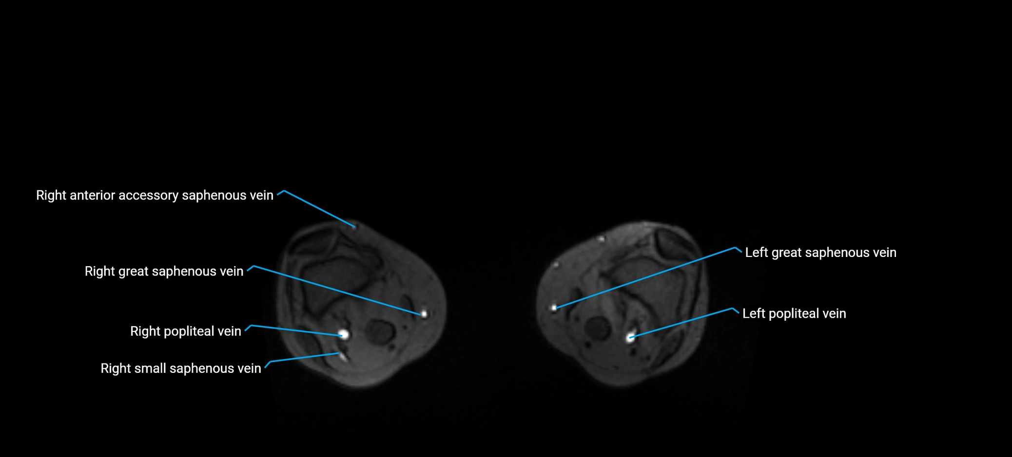 MRV abdomen pelvis & lower limb axial cross sectional anatomy labelled MRI image 354.webp